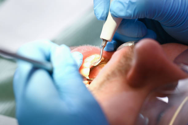 Best Chipped Tooth Repair Near Me  in Richton, MS